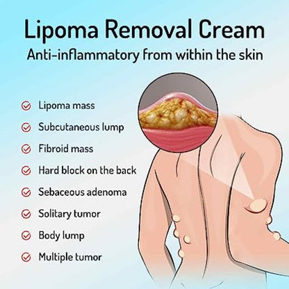 Lipoma Removal Cream